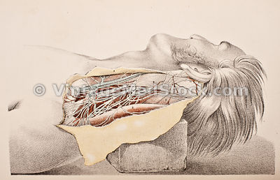 Post Mortem (Autopsy)